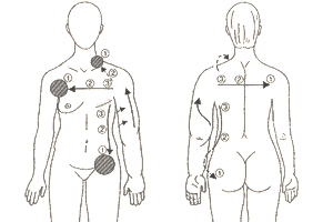 Armlymphödem