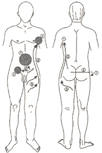 Beinlymphödem